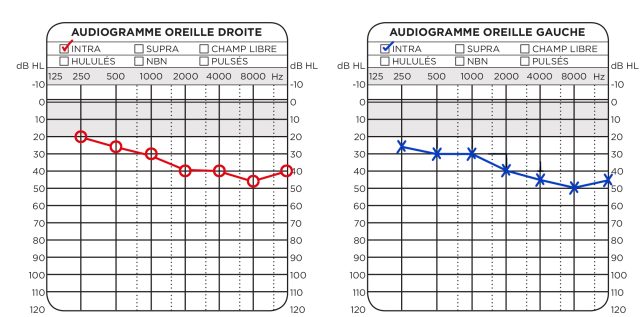 Images d'un audiogramme pour l'oreille gauche et pour l'oreille droite