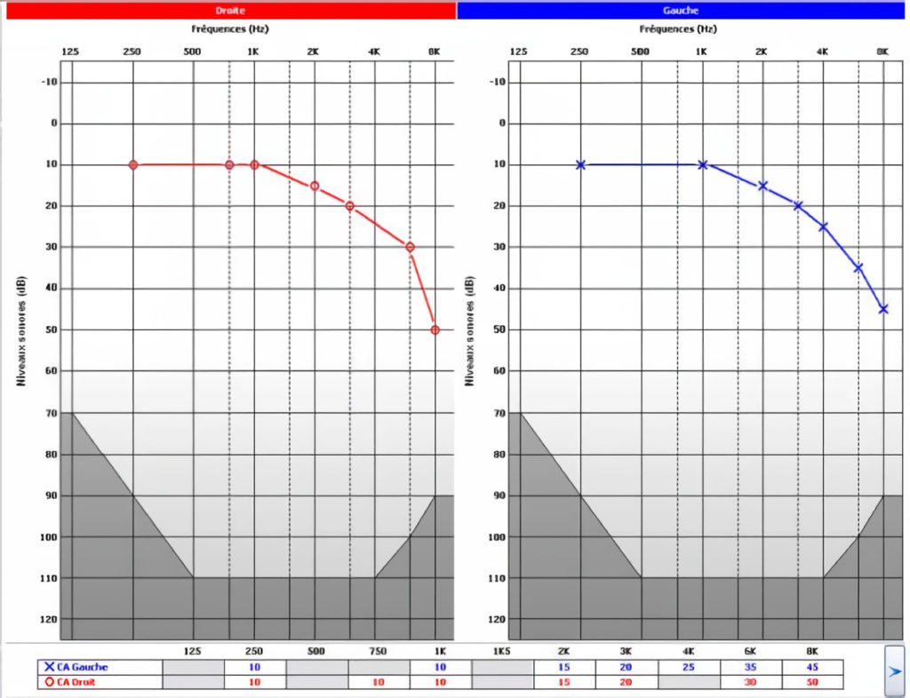 Audiogramme